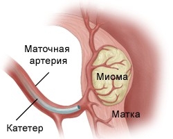 Эмболизация маточных артерий: современный взгляд