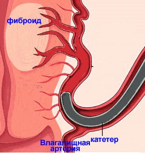Осложнения после эмболизации маточных артерий (ЭМА)