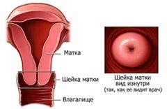 Классификация заболеваний шейки матки