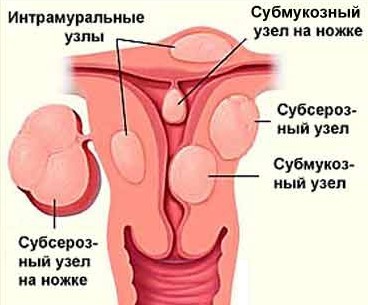 Как симптомы миомы матки зависят от размера и локализации узлов