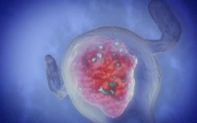 Опасность при удалении фиброзных опухолей матки