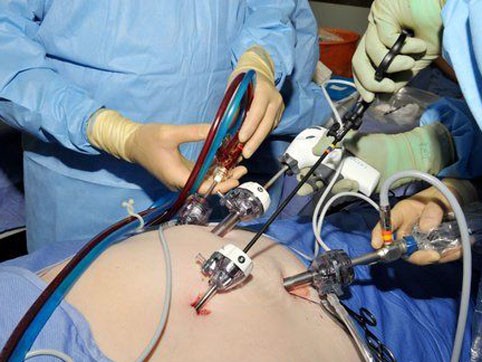 Лапароскопия при миоме матки